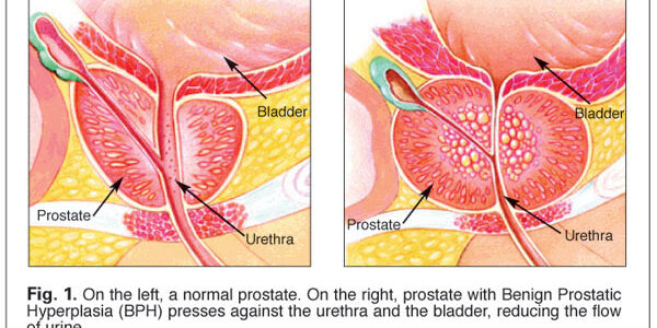 prostate-fig1