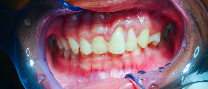 Periodontal,Condition.,Severe,Gum,Recession,At,Teeth,21,And,22.