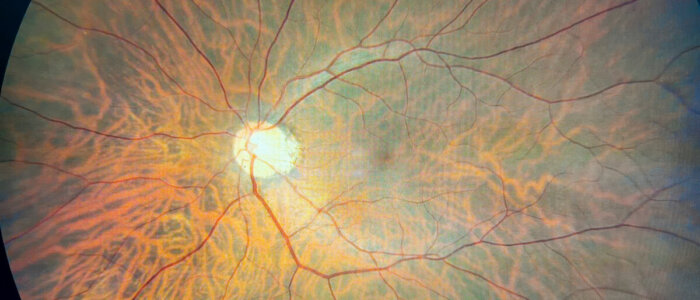 Photograph of Close Look at Retina of the Eye
