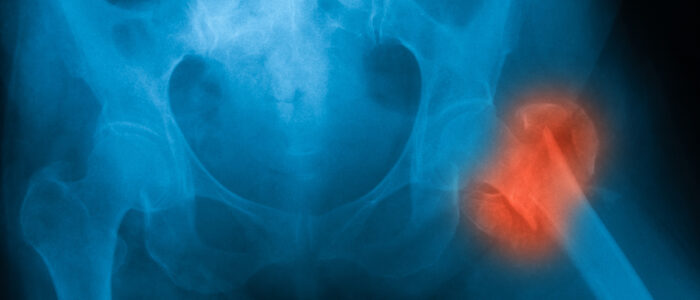 X-ray image of both hip showing femur fracture at left side.